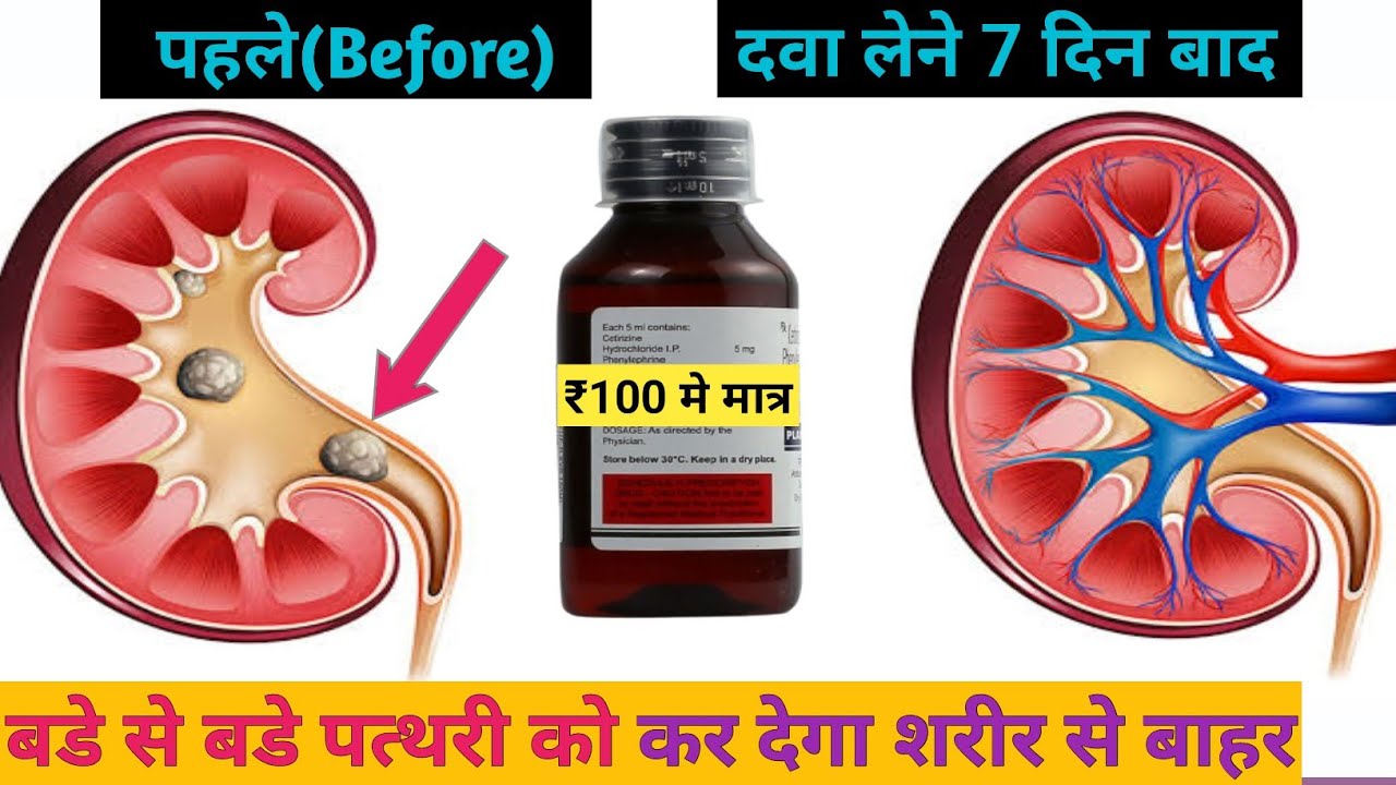 किडनी की पथरी का इलाज़/NEERI SYRUP/ALKASOL SYRUP/CYSTONE SYRUP USES/KIDNEY STONE की BEST SYRUPS