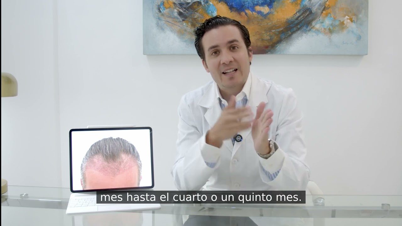 Qué pasa en un trasplante capilar a los 3 meses — Doctor Merlos
