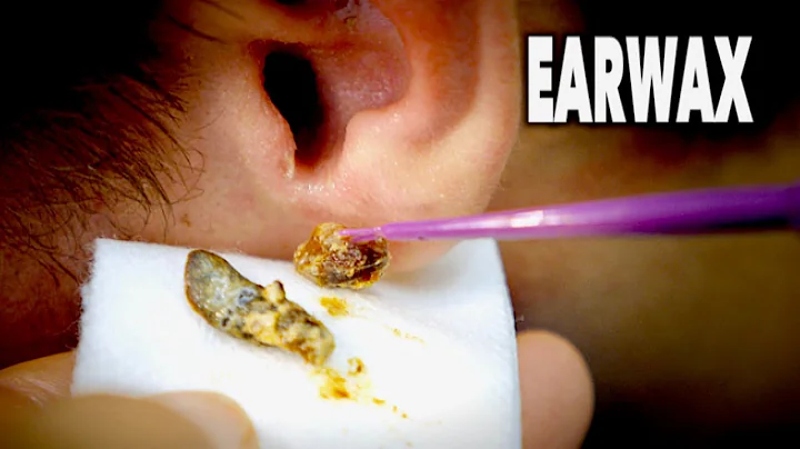 THE BEST EARWAX REMOVAL EVER!  (and most gross)  |...