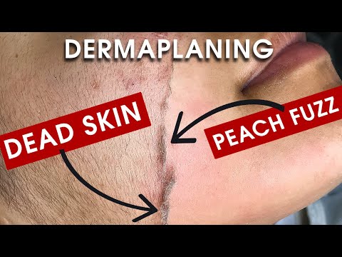 Video: Dermaplaning: Hvorfor Barberer Fasjonable Jenter Ansiktene Sine