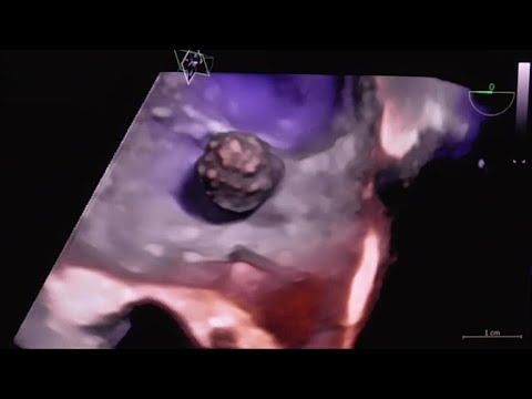 Video: Kdy byl srdeční myxom objeven?