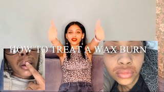 HOW TO TREAT A WAX BURN(DOES IT SCAR?)