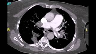 Cardiac Arrest - Mive Pulmonary Embolism