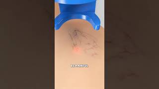 Using lasers to zap spider veins (3D Animation) Using lasers to zap spider veins (3D Animation)