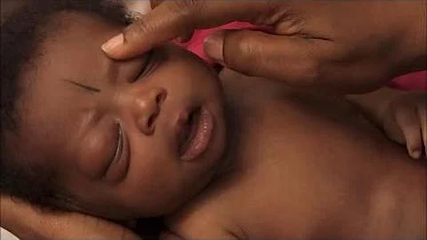 Sepsis (French) - Newborn Care Series