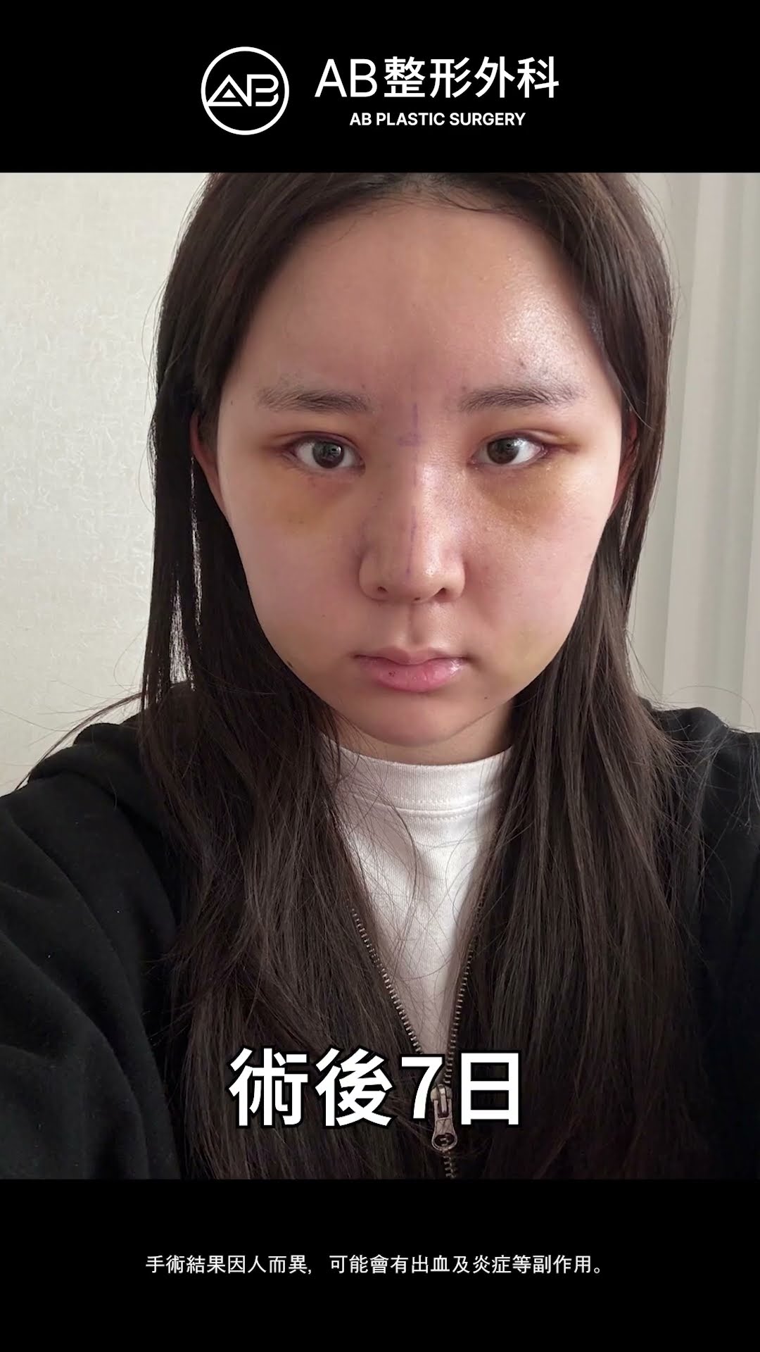 三重美丽提升：眼鼻整形结合脂肪移植 #Shorts