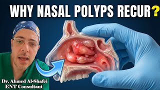 ⭐Nasal Polyps Explained: Why They Keep Coming Back & Treatment Options