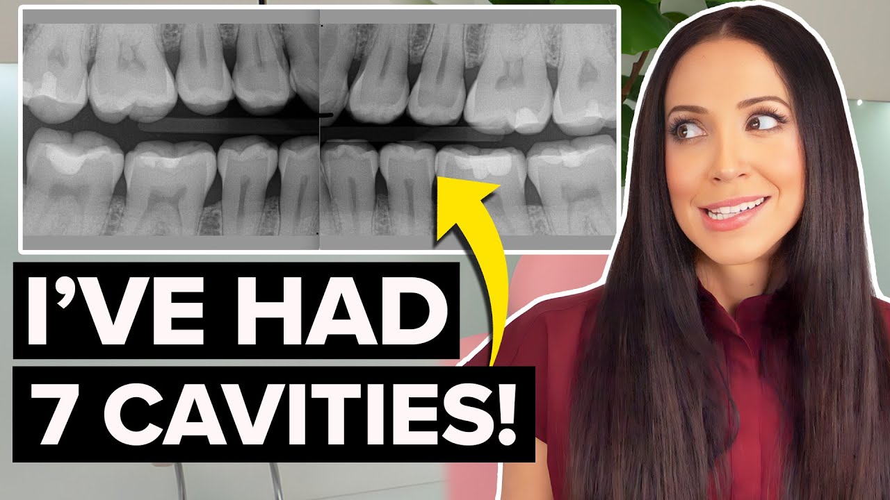 even DENTAL PROFESSIONALS get CAVITIES!