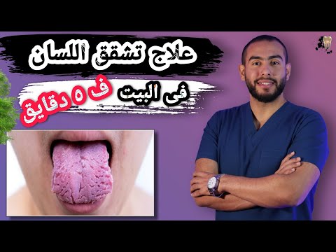 فيديو: كيف تعالج التشققات في لسانك: 8 خطوات (بالصور)