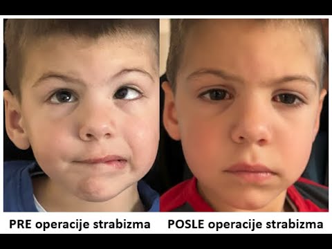 Operacija strabizma kod dece, specijalna bolnica Sveti Vid