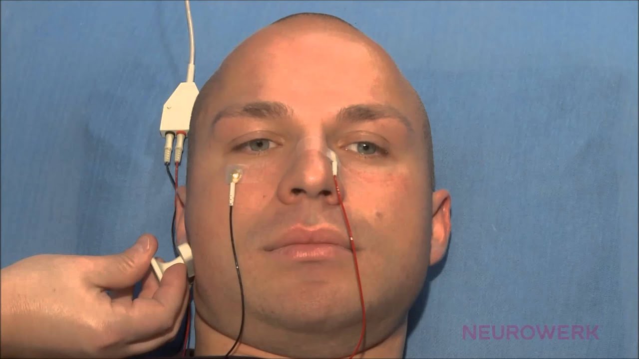 Motorische Neurographie - Repetetiv Facialis - YouTube