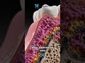 Laser Dentistry- How to save your teeth