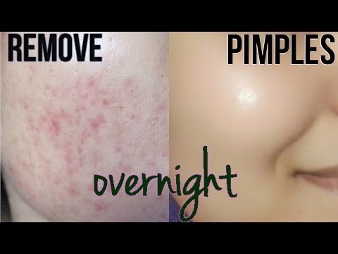 How To Remove Pimples Overnight | Acne Scar Treatment