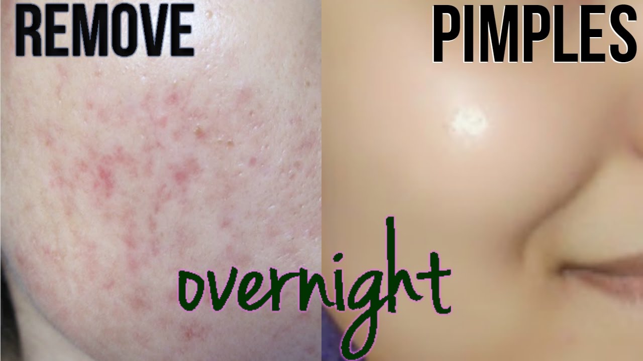 To at overnight how home remove acne How to