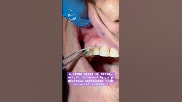 Sinus Tract, Fistula