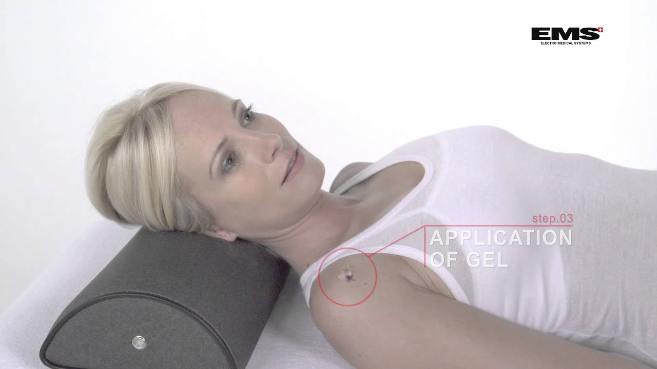 Shockwave Therapie - Calcifying Tendinitis of the Shoulder