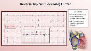 Advanced EKGs - The Subtypes of Atrial Flutter (typical vs. reverse typical vs. atypical)