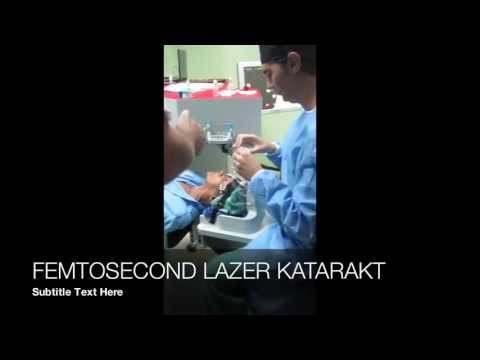 KATARAKT 3 Bıçaksız Katarakt Ameliyatı Femtosaniye Lazer Efekan Coskunseven