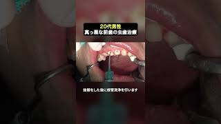 1回の治療で一気に前歯を綺麗に‼️#ザホワイトデンタルクリニック  #歯医者  #虫歯