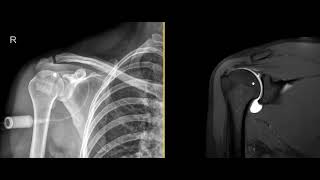 What is an MRI shoulder arthrogram?