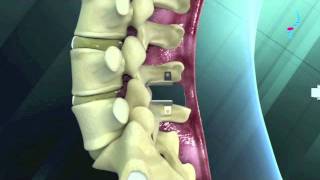 Dynamische Stabilisierung Mit Leu Und Pfliff