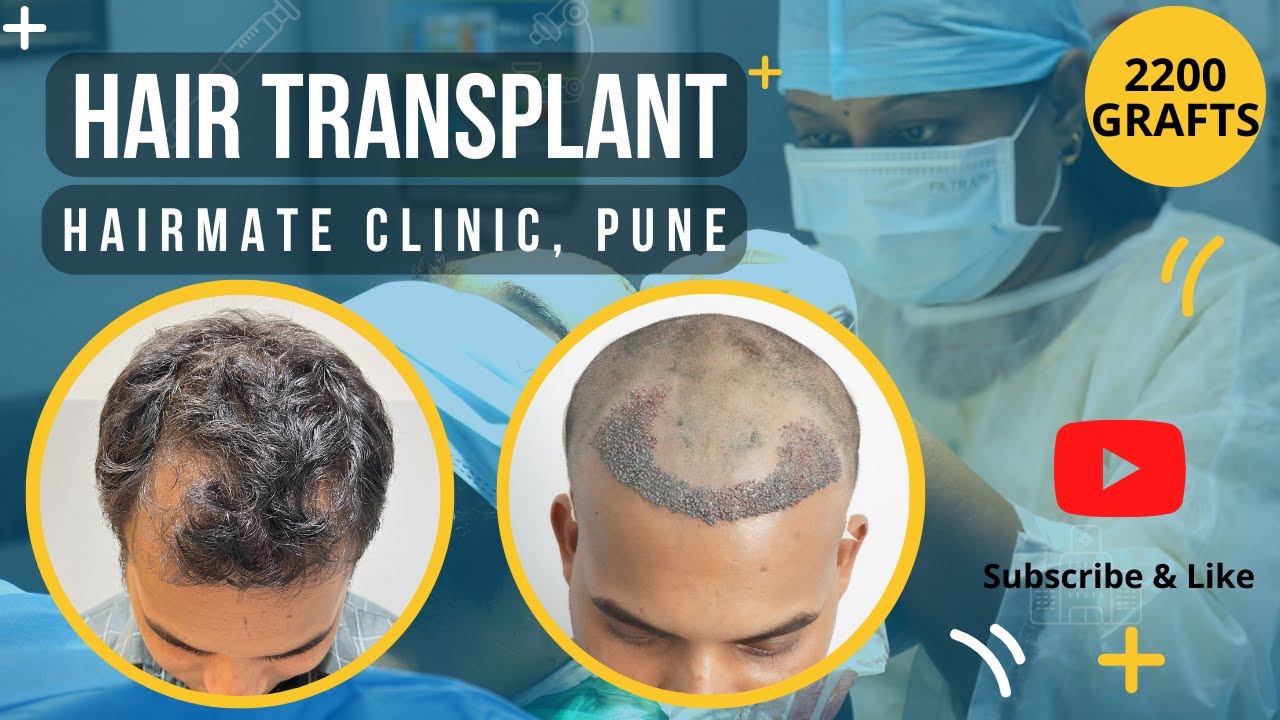 Hair Transplant in Pune Hairmate Clinic Pune Hair Transplant
