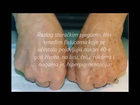 Video: Kako dermatolog uklanja tamne mrlje?