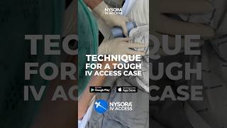 Technique for Tough IV Access cases #intravenous