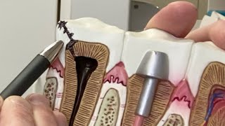 What is a Cavity?