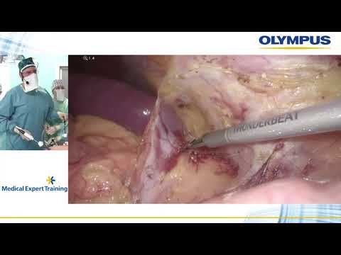 Видео: Хирургия при эндометриозе