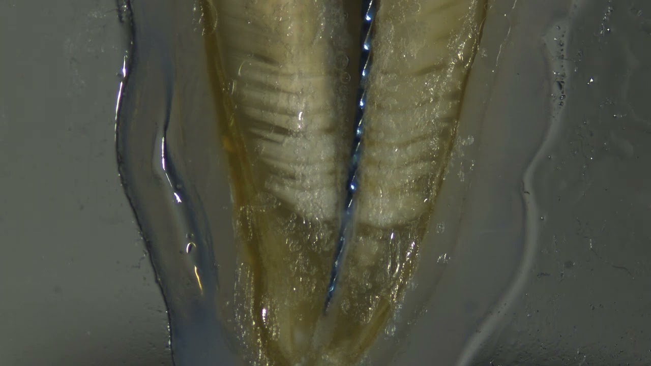 Endosonic Blue2 : Apical Drainage & Negative pressure 2