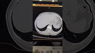 HRCT Pneumonia vs GGO Pattern | Chest CT #shorts