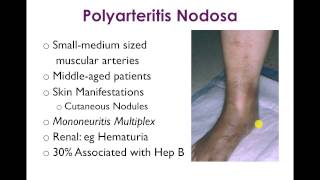Vasculitis 2