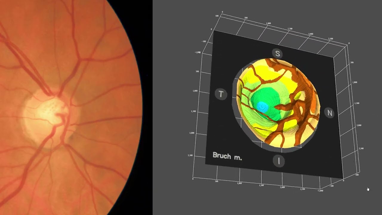 3D visualization of the optic nerve head morphology from standard 2D retinal images from RetinaLyze
