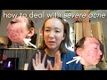 HOW TO DEAL WITH SEVERE ACNE (confidence, mindset, self worth)