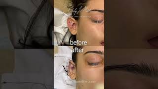 Operation Room Table Results Revealed | Otoplasty, aka Ear-Pinning Surgery screenshot 5