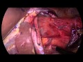 Giant hiatal hernia repair with posterior  (Toupet's) fundoplication.  "Unedited" By Prof Yerdel