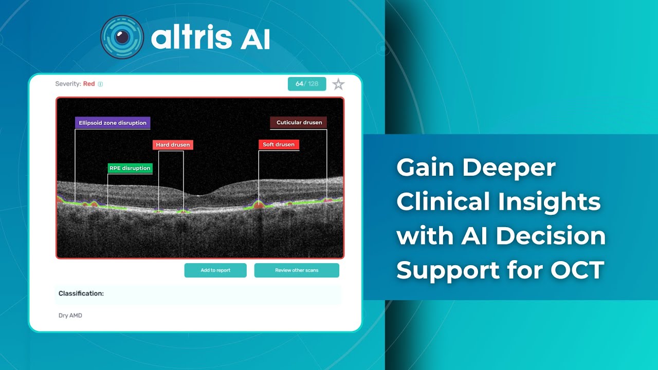 AI for Ophthalmology: Decision Support for OCT Analysis
