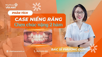 Phân Tích Case Niềng Răng Chen Chúc Nặng 2 Hàm!