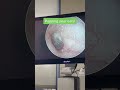Popping / equalizing ear pressure for airplanes, diving and Eustachian tube dysfunction