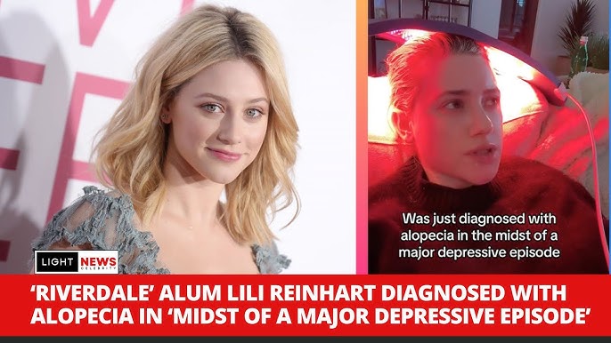 Omg Lili Reinhart Reveals She Was Diagnosed With Alopecia And Hair Loss Threat