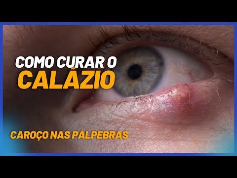 Calázio e hordéolo (terçol): Causas Sintomas e Tratamentos – EYECOLORS –  Vison Care