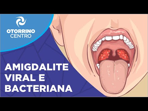 Vídeo: Diferença Entre Amigdalite E Febre Glandular