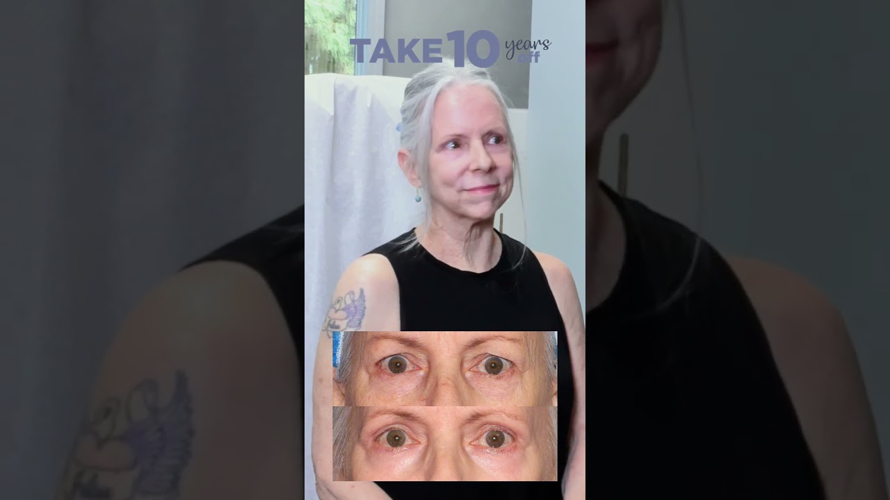 Banner for People tell me I have beautiful skin now!” - Shawn, patient testimonial after Take10 #take10