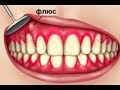 Как вылечить флюс  Советы стоматолога  Эндодонтия  Терапевтическая стоматология