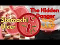 How Stomach Ulcers Really Form | Peptic ulcer, Causes, Symptoms & Treatment Explained Simply
