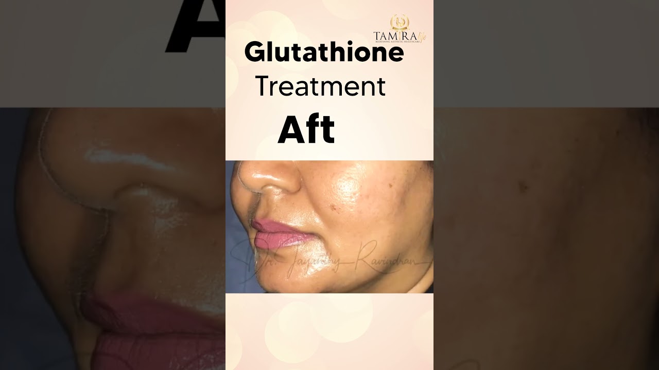 glutathione skin transformation latest See Whitening Before And After: A Journey This patient got into her
