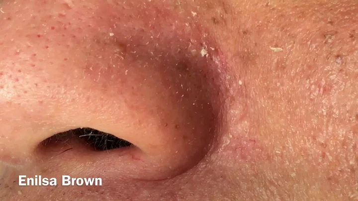 The ultimate extractions of the Nose and More on D...