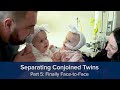 Separating Conjoined Twins Part 5: Finally Face-to-Face