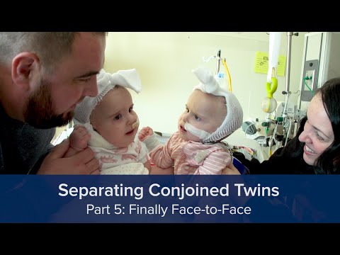 Separating Conjoined Twins
